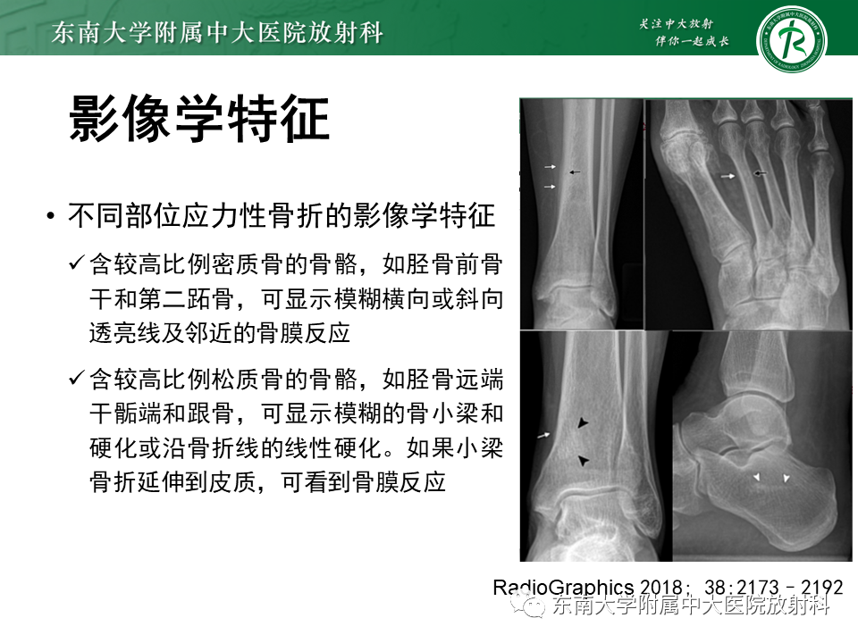 影像PPT - 【PPT】应力性骨折-13