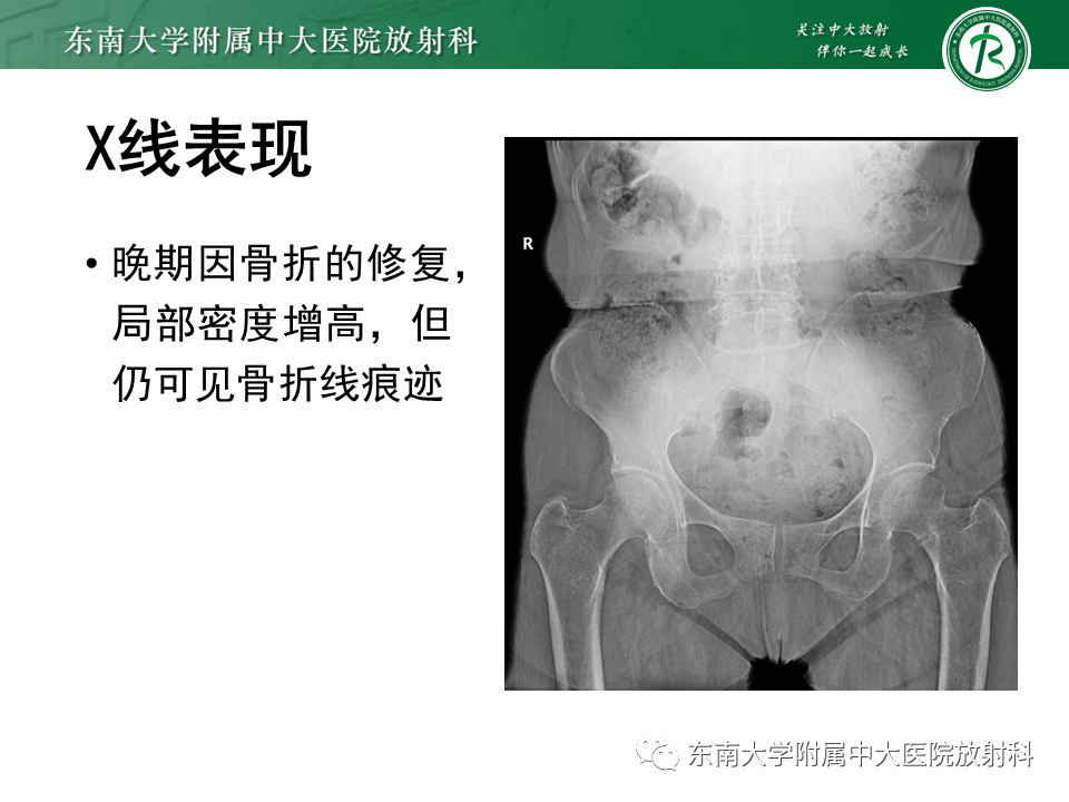 影像PPT - 【PPT】应力性骨折-16