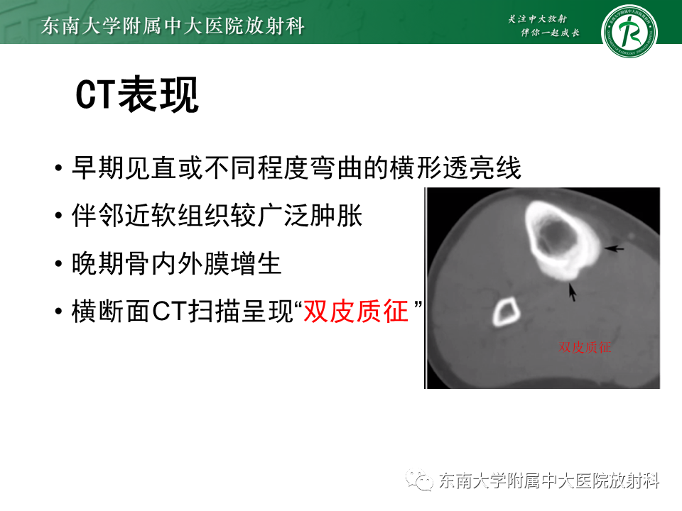 影像PPT - 【PPT】应力性骨折-19