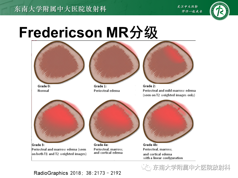 影像PPT - 【PPT】应力性骨折-21