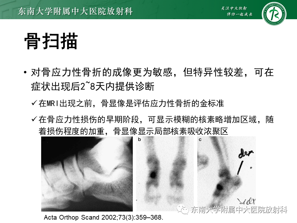影像PPT - 【PPT】应力性骨折-18