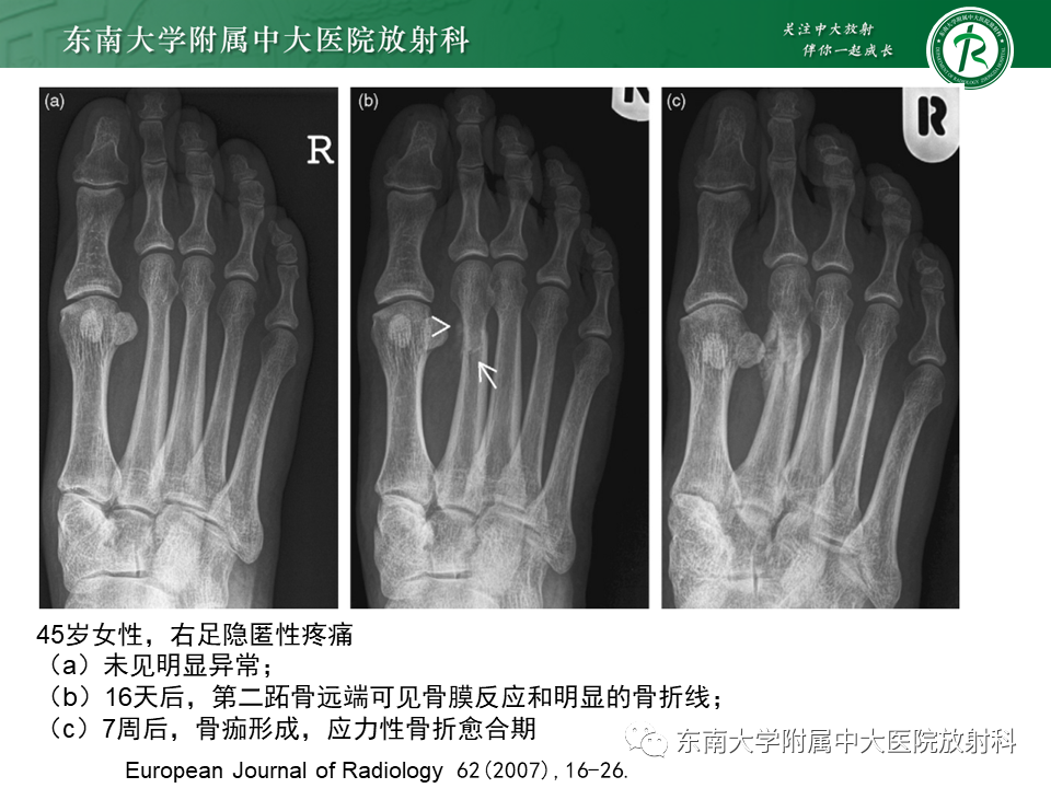 影像PPT - 【PPT】应力性骨折-17