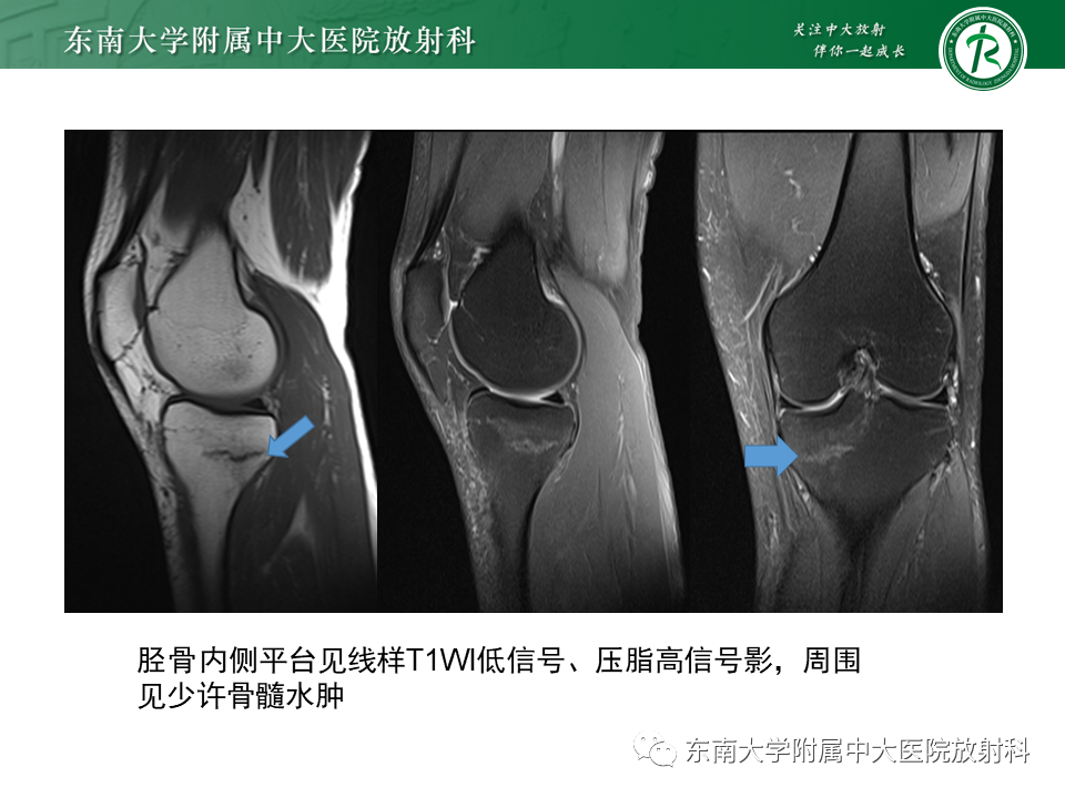 影像PPT - 【PPT】应力性骨折-22
