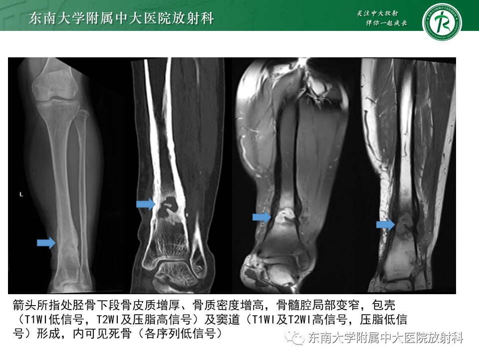 影像PPT - 【PPT】应力性骨折-26