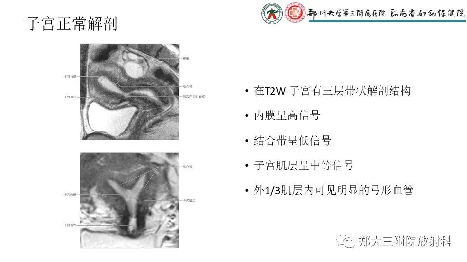 影像PPT - 【PPT】子宫腺肌症的MRI表现-4