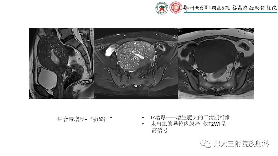 影像PPT - 【PPT】子宫腺肌症的MRI表现-8