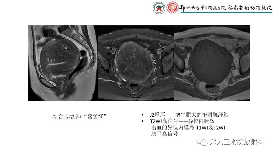 影像PPT - 【PPT】子宫腺肌症的MRI表现-9