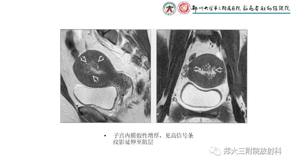 影像PPT - 【PPT】子宫腺肌症的MRI表现-10