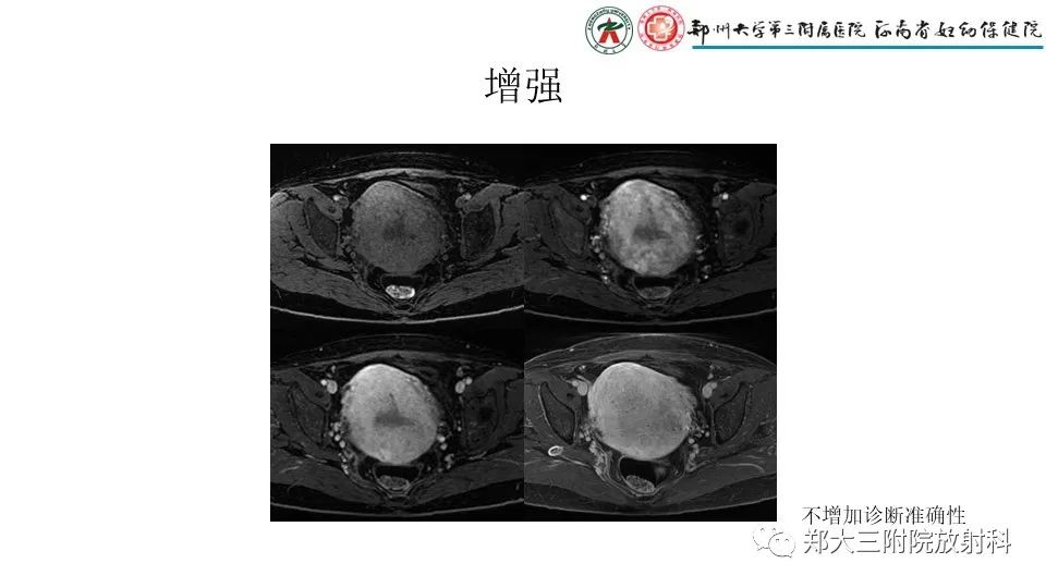 影像PPT - 【PPT】子宫腺肌症的MRI表现-11