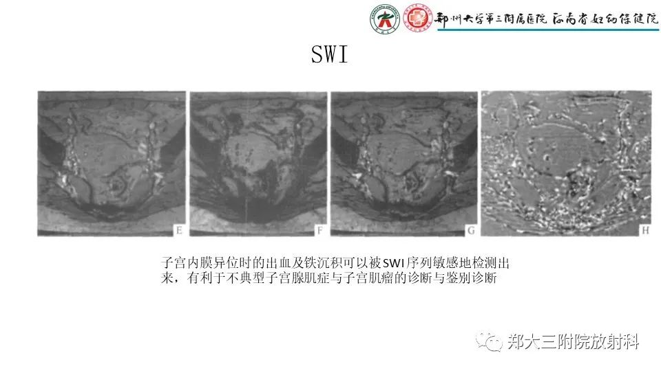 影像PPT - 【PPT】子宫腺肌症的MRI表现-12