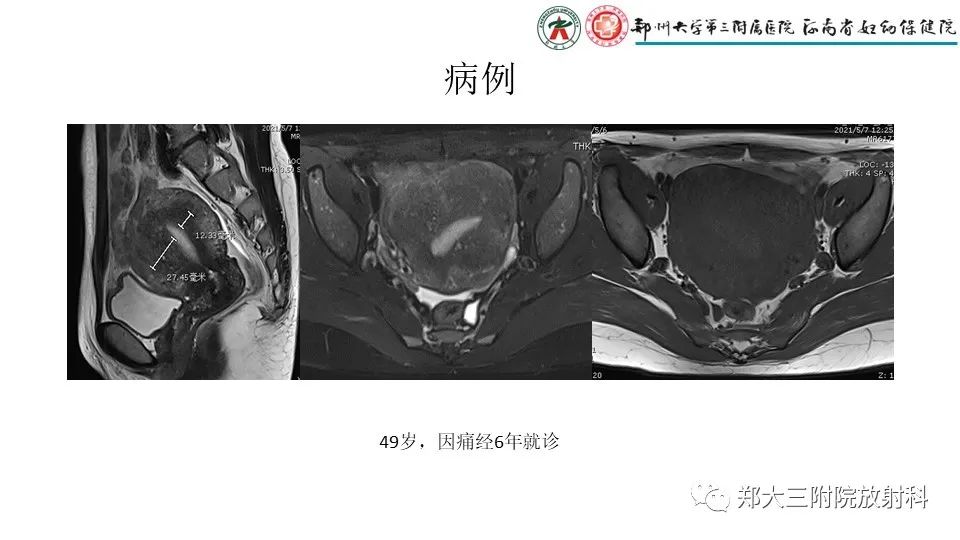 影像PPT - 【PPT】子宫腺肌症的MRI表现-13