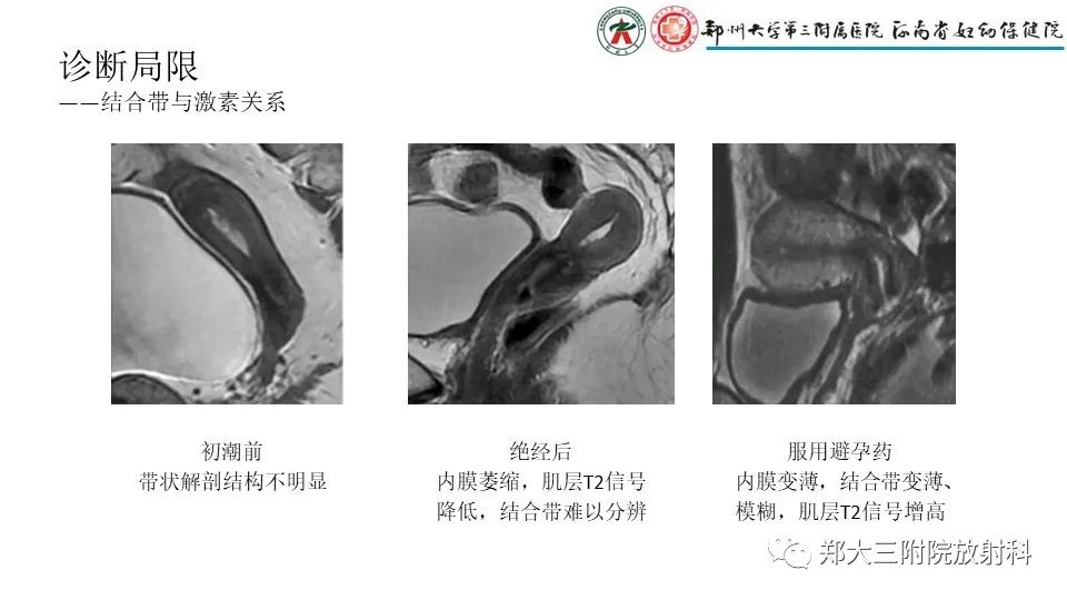 影像PPT - 【PPT】子宫腺肌症的MRI表现-15