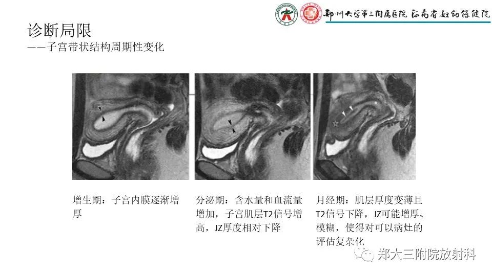 影像PPT - 【PPT】子宫腺肌症的MRI表现-16
