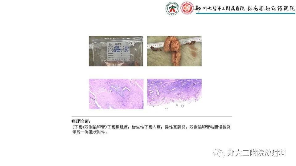 影像PPT - 【PPT】子宫腺肌症的MRI表现-14