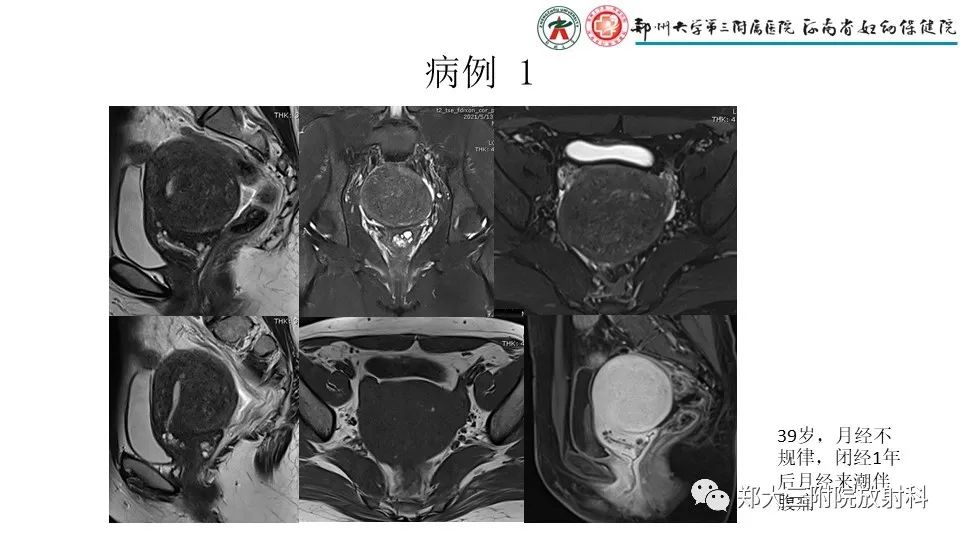 影像PPT - 【PPT】子宫腺肌症的MRI表现-19