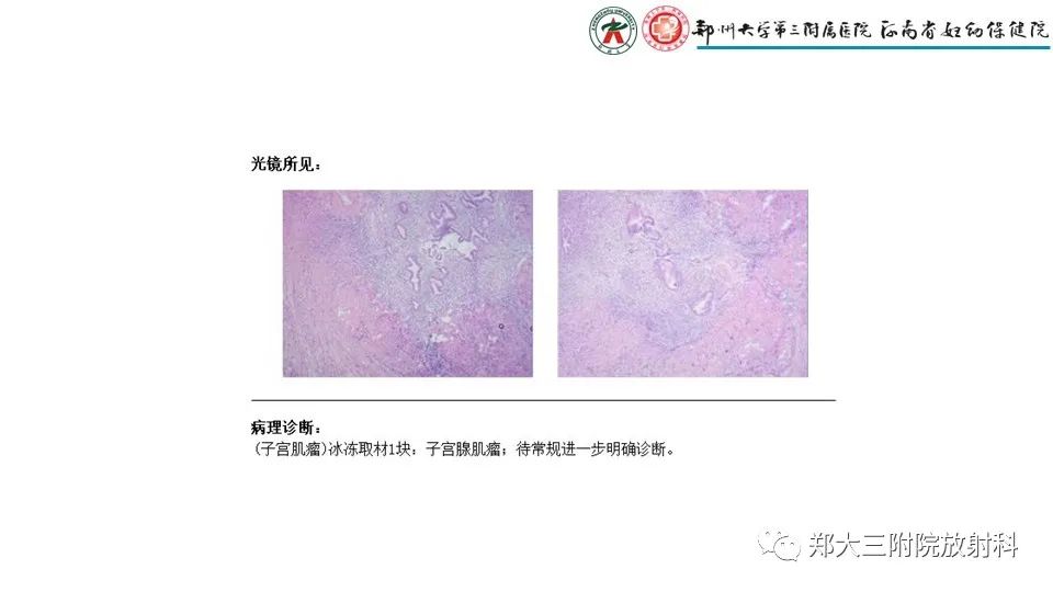 影像PPT - 【PPT】子宫腺肌症的MRI表现-20