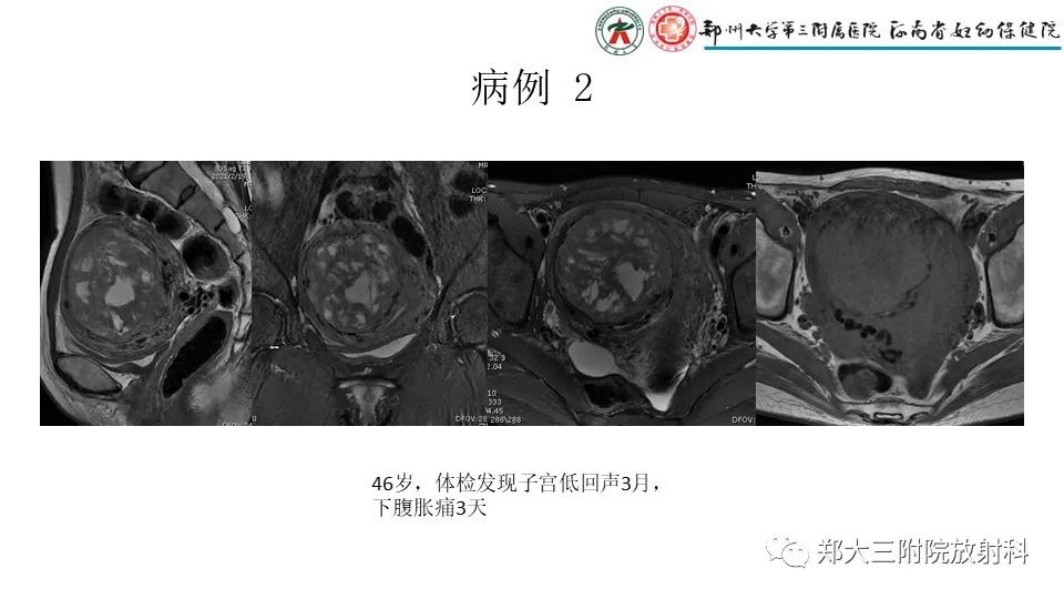影像PPT - 【PPT】子宫腺肌症的MRI表现-21