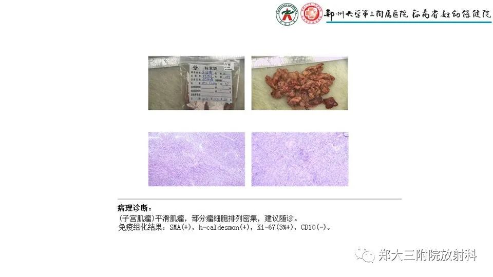 影像PPT - 【PPT】子宫腺肌症的MRI表现-22