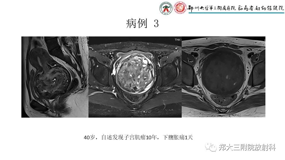 影像PPT - 【PPT】子宫腺肌症的MRI表现-24