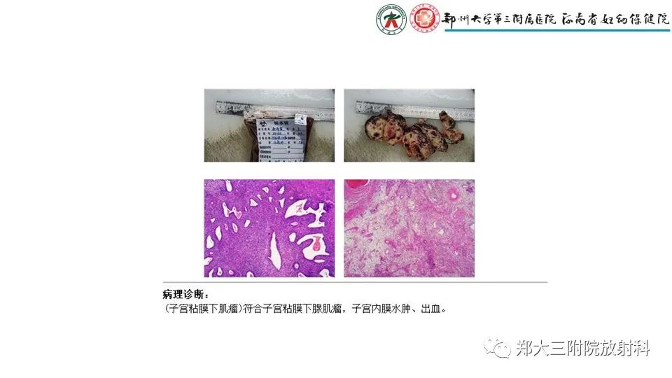 影像PPT - 【PPT】子宫腺肌症的MRI表现-25
