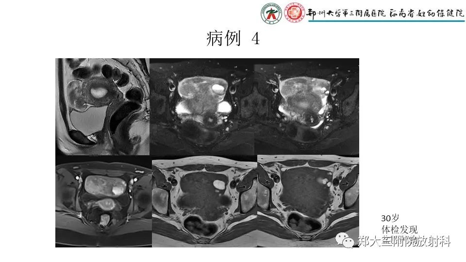 影像PPT - 【PPT】子宫腺肌症的MRI表现-26