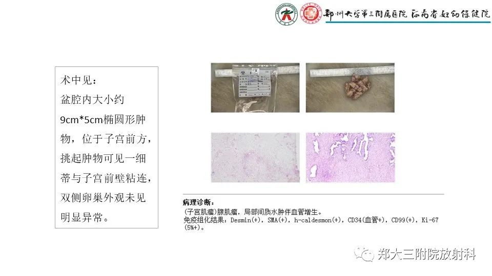 影像PPT - 【PPT】子宫腺肌症的MRI表现-27