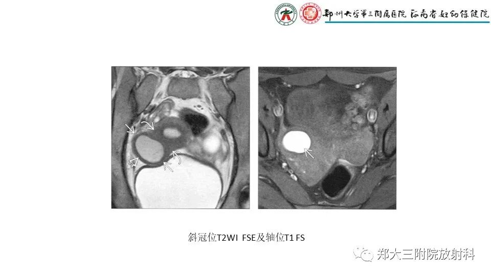 影像PPT - 【PPT】子宫腺肌症的MRI表现-30