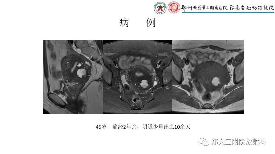 影像PPT - 【PPT】子宫腺肌症的MRI表现-31
