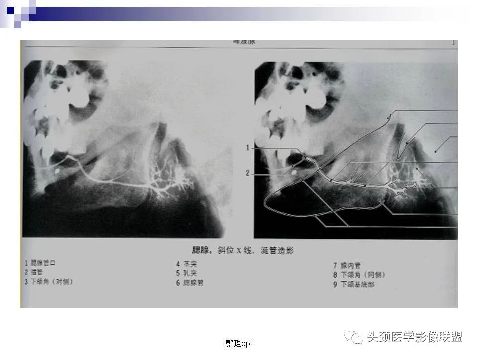 影像PPT - 【PPT】涎腺疾病的影像诊断-17