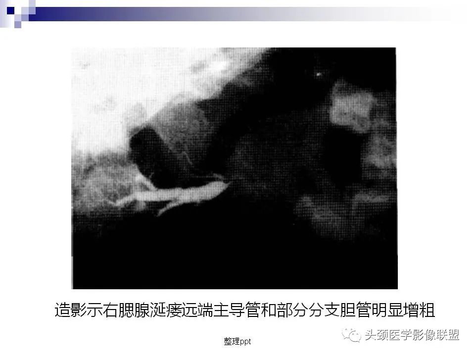 影像PPT - 【PPT】涎腺疾病的影像诊断-24