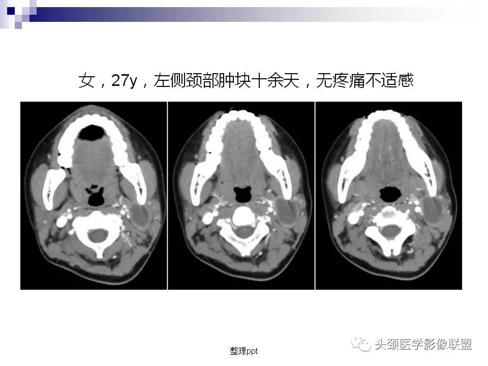 影像PPT - 【PPT】涎腺疾病的影像诊断-34