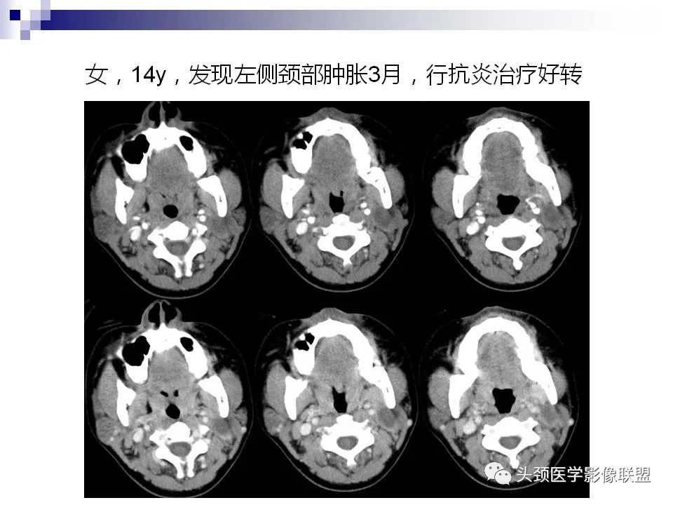 影像PPT - 【PPT】涎腺疾病的影像诊断-35