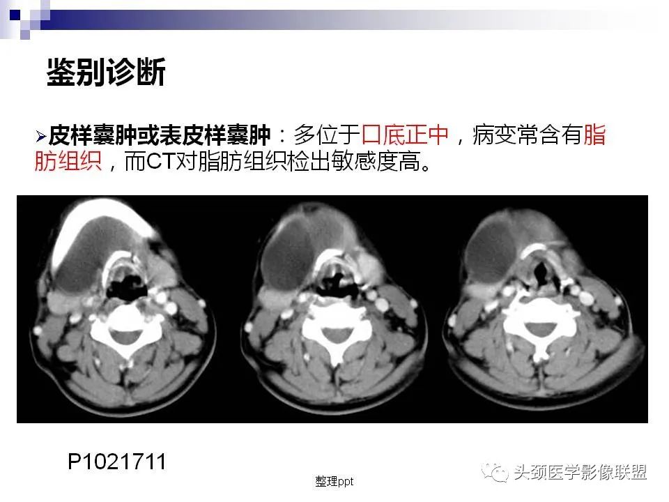 影像PPT - 【PPT】涎腺疾病的影像诊断-36