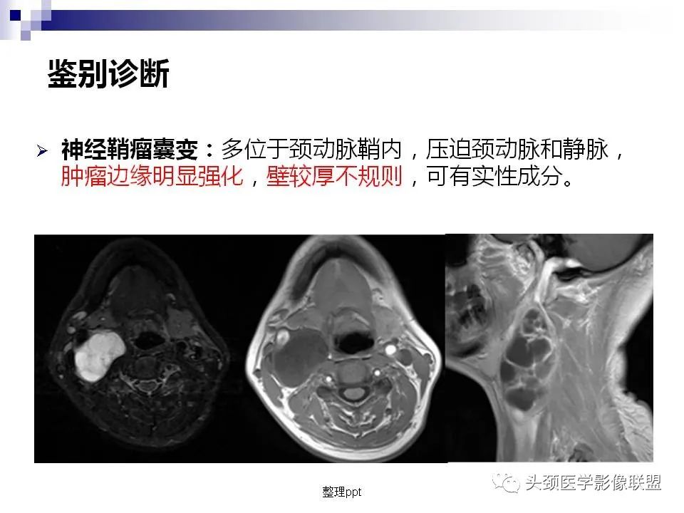 影像PPT - 【PPT】涎腺疾病的影像诊断-37