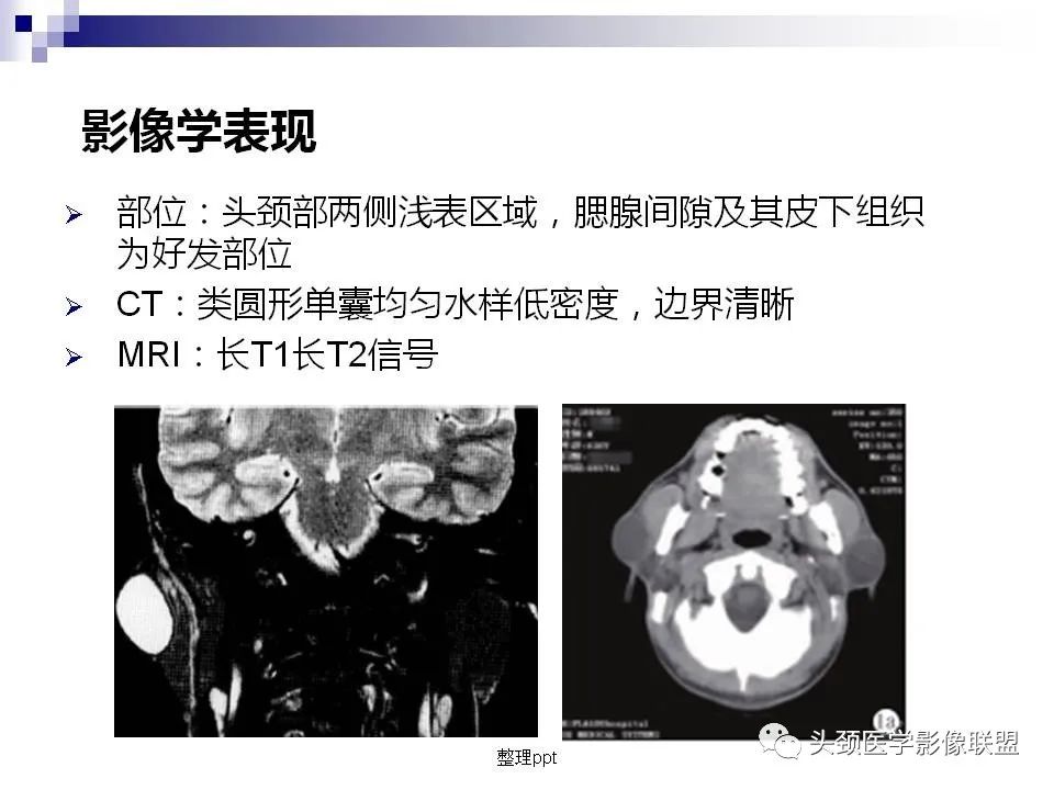 影像PPT - 【PPT】涎腺疾病的影像诊断-42