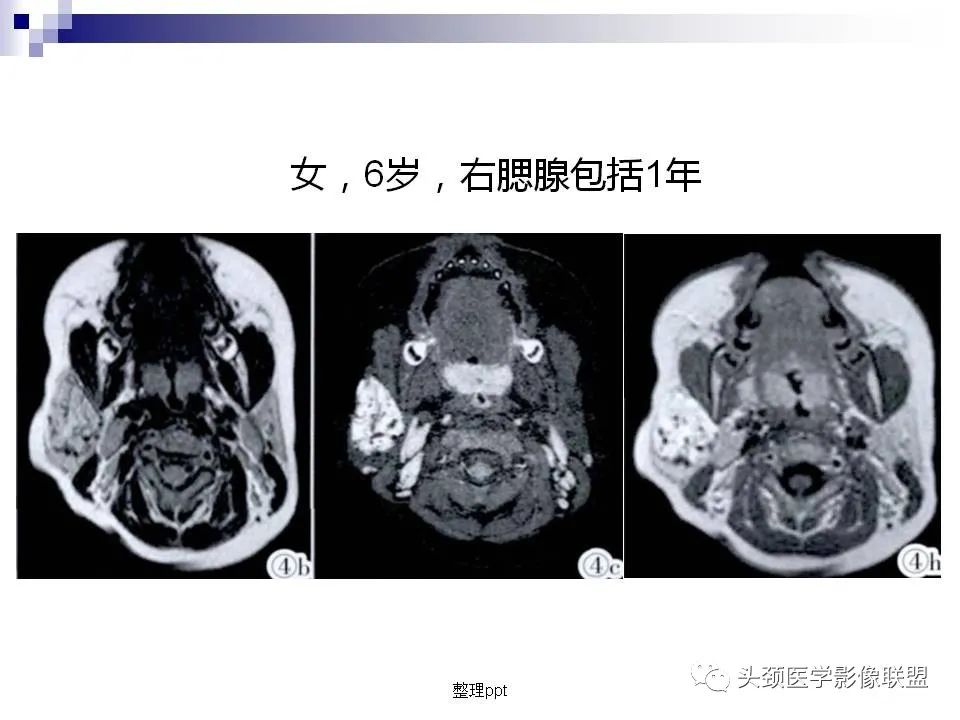 影像PPT - 【PPT】涎腺疾病的影像诊断-47