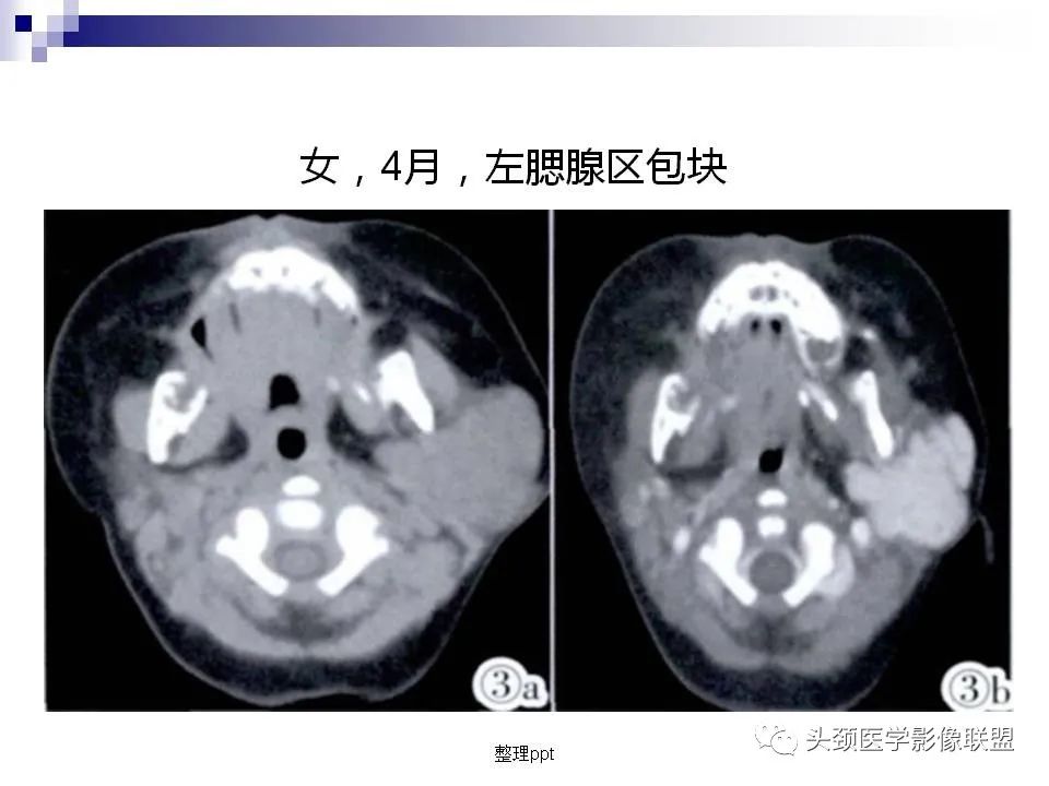 影像PPT - 【PPT】涎腺疾病的影像诊断-46
