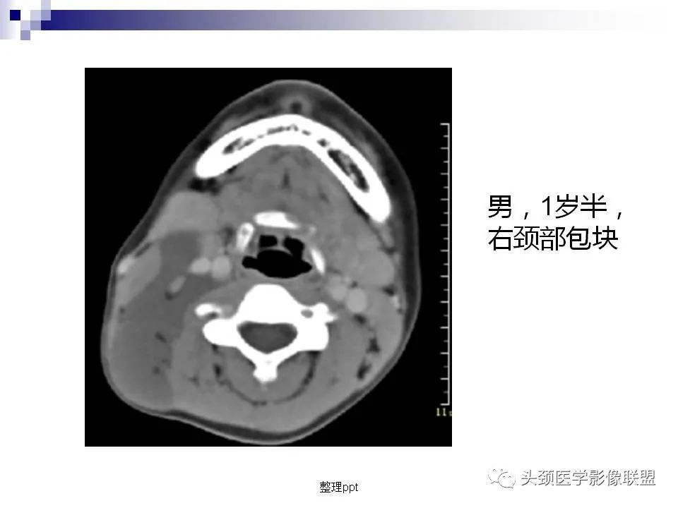 影像PPT - 【PPT】涎腺疾病的影像诊断-54