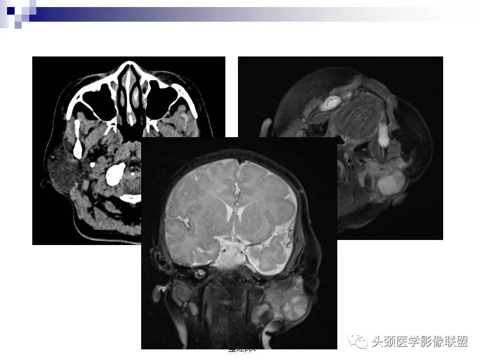 影像PPT - 【PPT】涎腺疾病的影像诊断-60