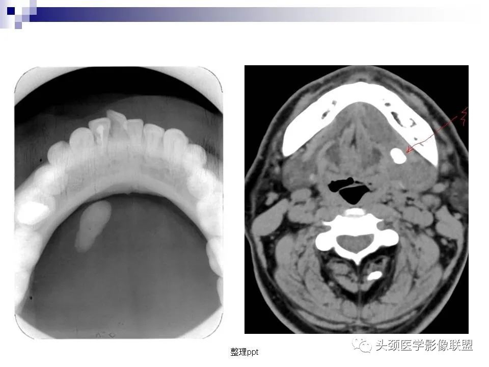 影像PPT - 【PPT】涎腺疾病的影像诊断-68