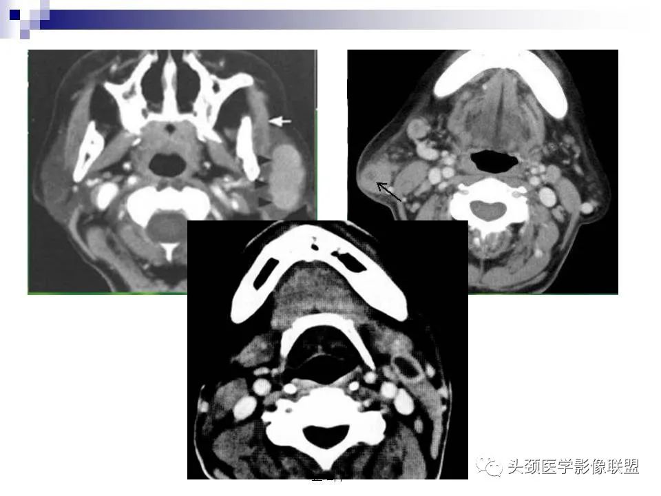 影像PPT - 【PPT】涎腺疾病的影像诊断-71