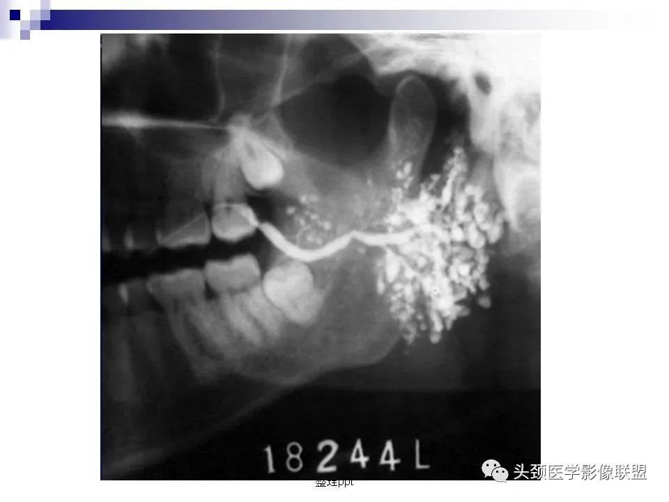 影像PPT - 【PPT】涎腺疾病的影像诊断-76