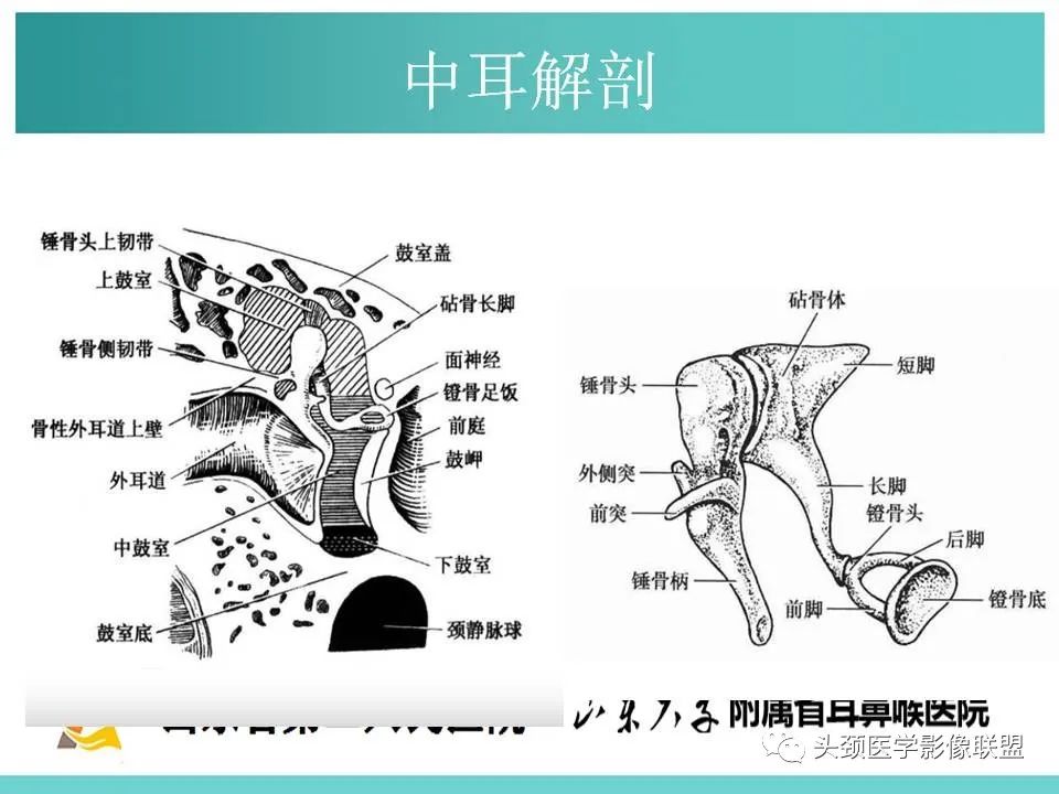 影像PPT - 【PPT】慢性中耳乳突炎-7