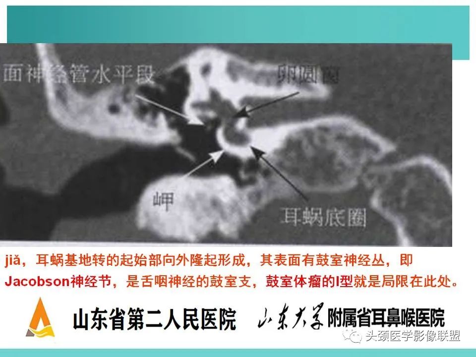 影像PPT - 【PPT】慢性中耳乳突炎-8