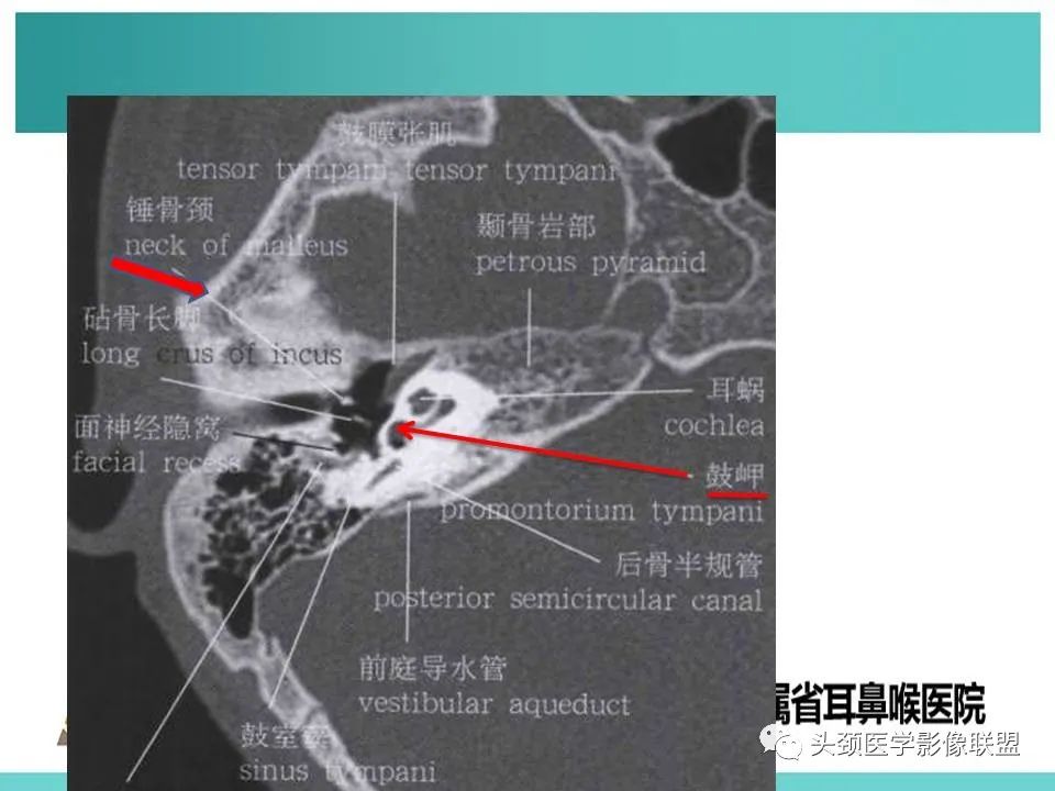 影像PPT - 【PPT】慢性中耳乳突炎-9