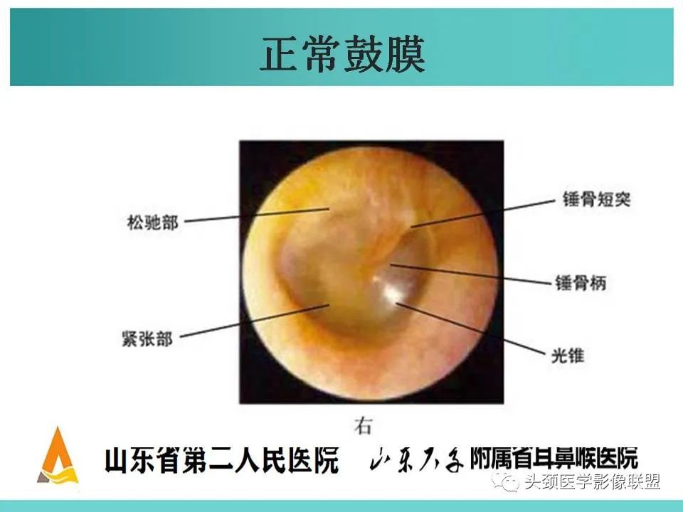 影像PPT - 【PPT】慢性中耳乳突炎-25