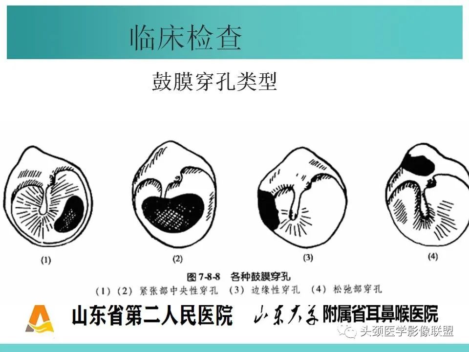 影像PPT - 【PPT】慢性中耳乳突炎-26