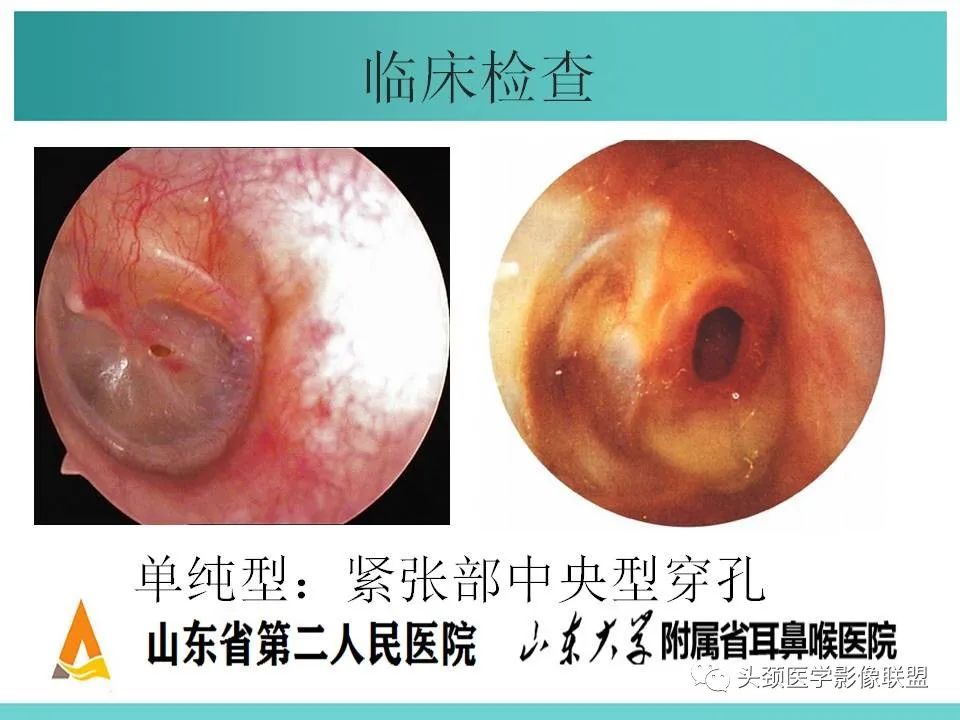 影像PPT - 【PPT】慢性中耳乳突炎-27