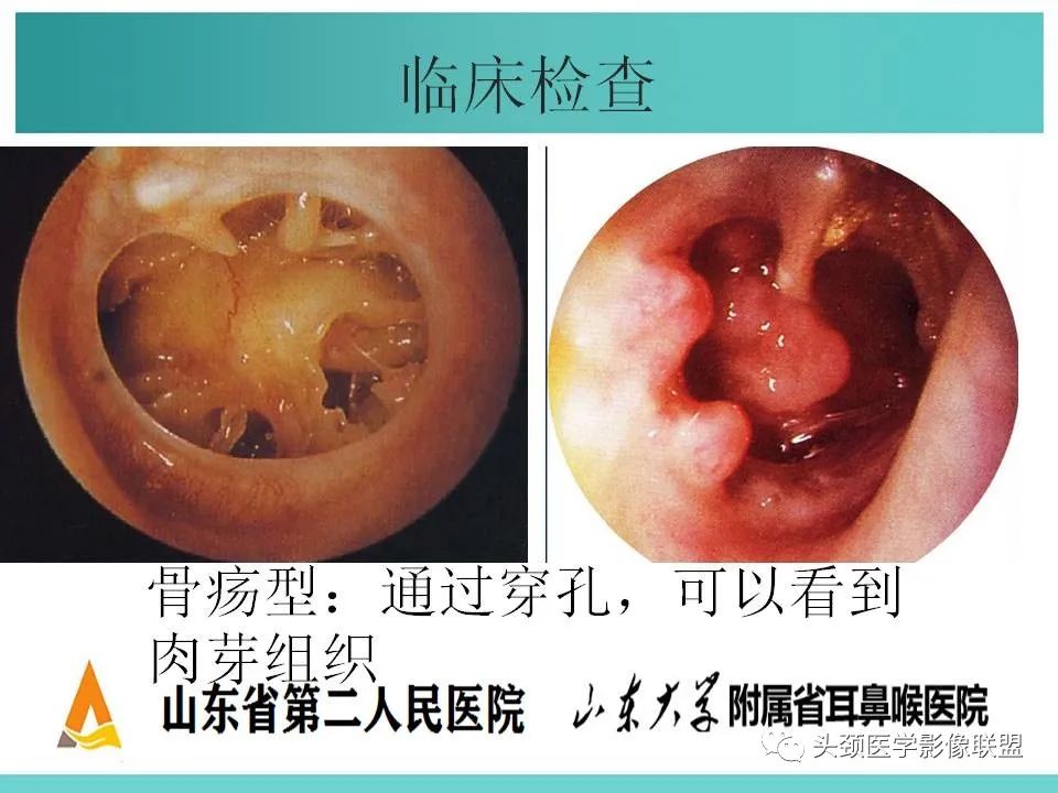 影像PPT - 【PPT】慢性中耳乳突炎-28