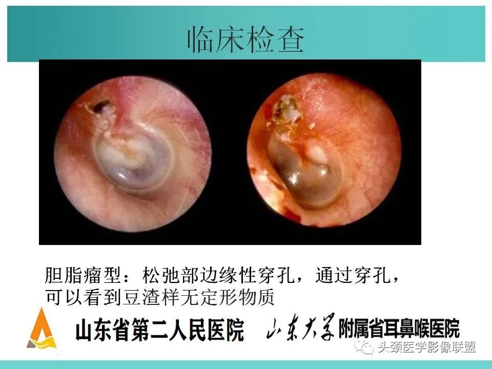 影像PPT - 【PPT】慢性中耳乳突炎-29